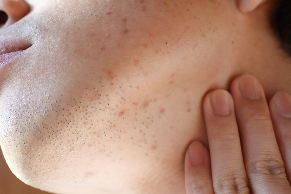 What is Hyperpigmentation?